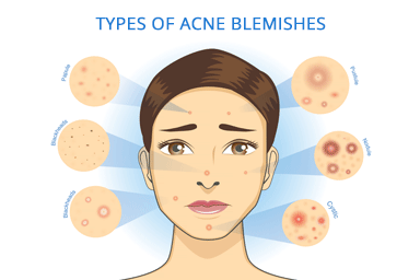 Illustration of woman with different types of acne blemishes on face