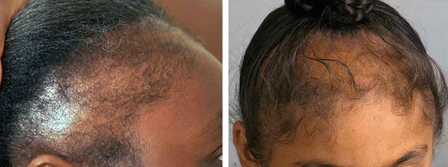 Woman with traction alopecia holding hair back to show receding hairline (left). Woman with thinning hair on crown of head from traction alopecia (right).