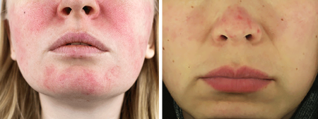 Redness on face due to rosacea (left), Asian woman with rosacea (right).
