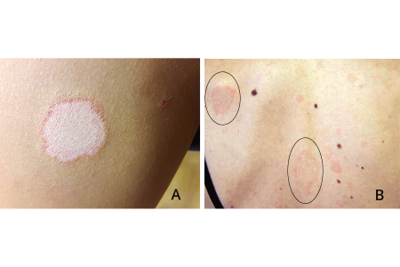 Pink herald patch (A). Two herald patches and widespread rash (B).