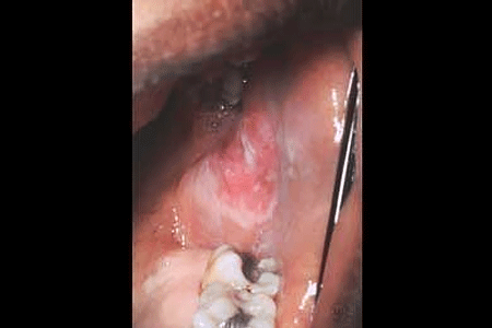 Discoid lupus in the mouth