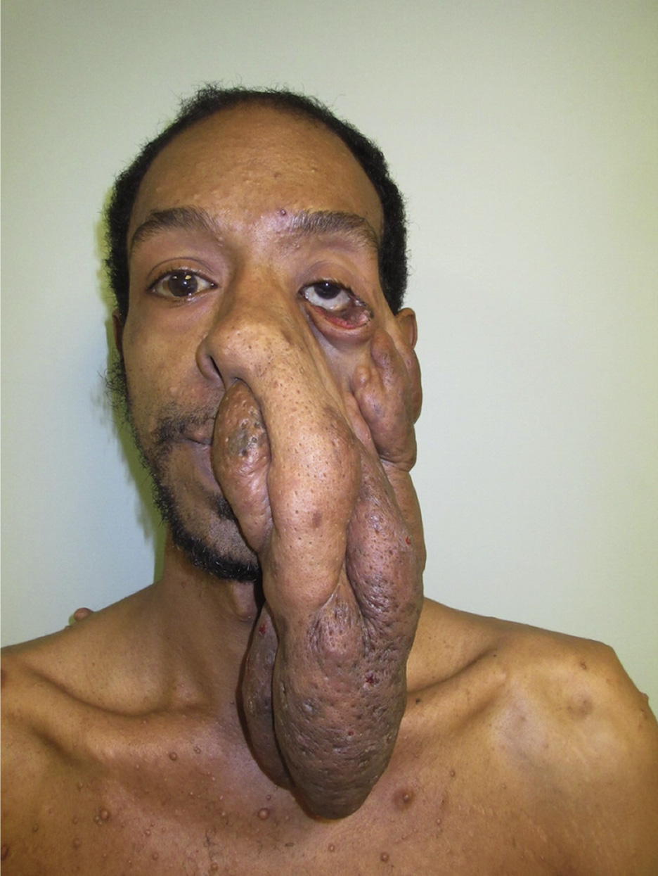 Photo of for DWII on Caveat mTOR revisited: Neurofibromatosis