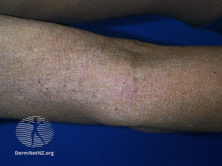 swollen leg from atopic dermatitis