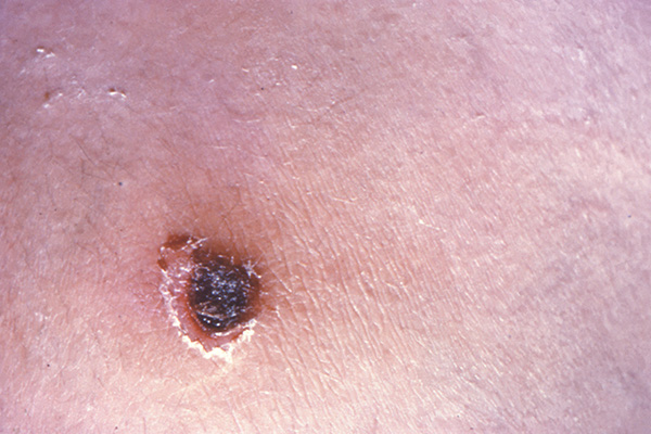 Figure 1. Superficial ulcer with sharply demarcated borders and surrounding skin with violaceous induration. Source: CDC. (2)