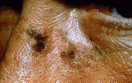 Brown spots on a man's face and bridge of nose are actinic keratoses precancerous growths