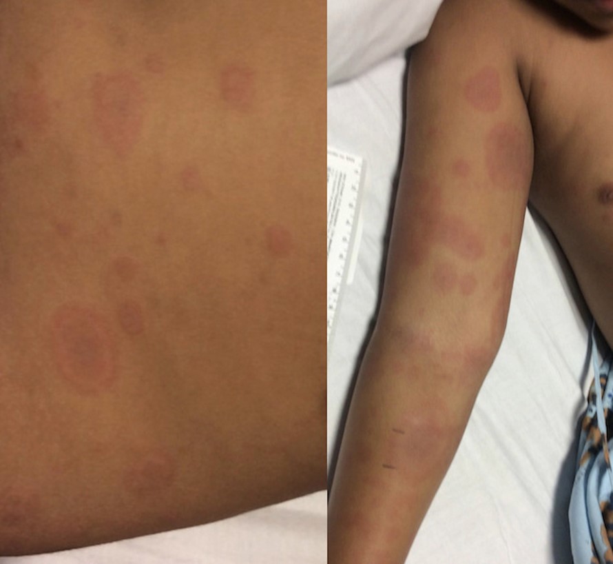 Image from Shwe S et al. Erythema multiforme in a child with Kawasaki disease. JAAD Case Rep 2019; 5: 386-388.