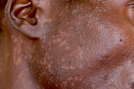 Seborrheic dermatitis rash causing light spots on man’s face