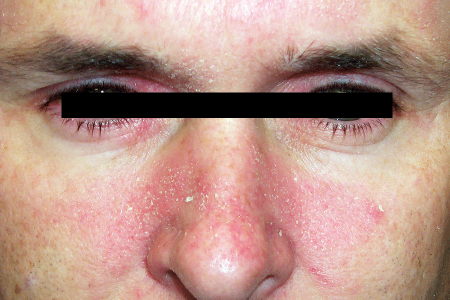 Seborrheic dermatitis rash on eyelids, nose, and cheeks