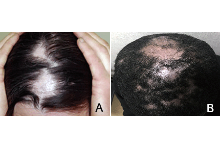 Two large patches of alopecia areata on top of scalp (A) and patches of alopecia areata of different sizes on man’s head (B)
