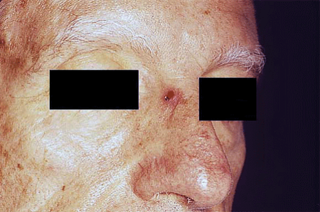 Merkel cell carcinoma on bridge of nose of senior man