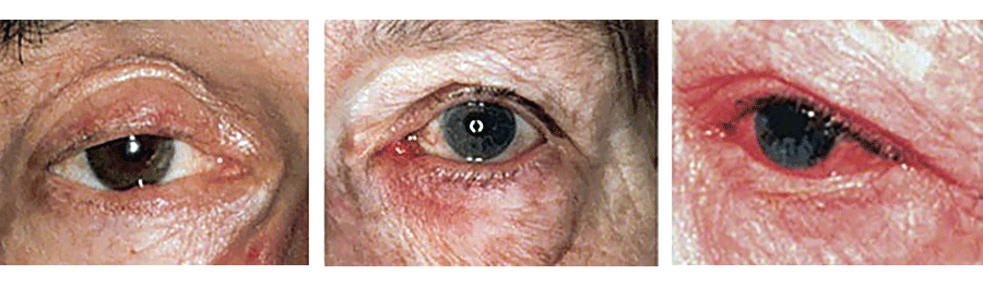 Public>Diseases>Rosacea>Symptoms>Eye changes
