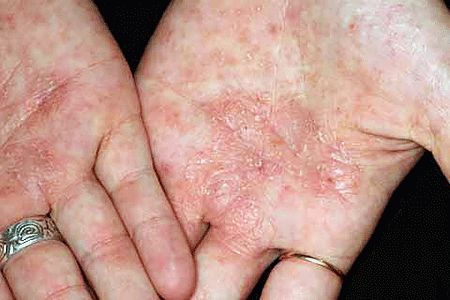 Dyshidrotic eczema on woman’s palms