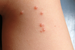 White raised bumps on skin toddler