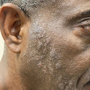 Card image for DWII on allergen of the year 2025 showing the face of a man with a darker skin tone whose skin is showing signs of an allergic reaction | American Academy of Dermatology (AAD)