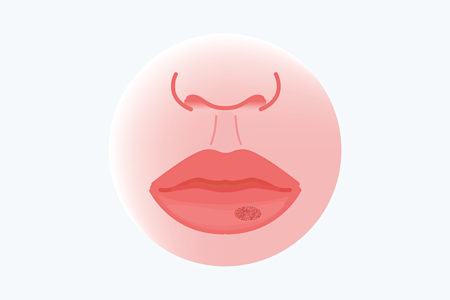 Card illustration for lip procedures