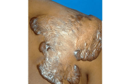 Large keloid scar on back and shoulder