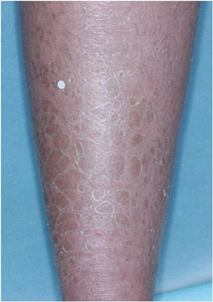 Image of lamellar ichthyosis