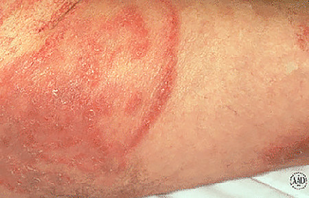 cutaneous t cell lymphoma face