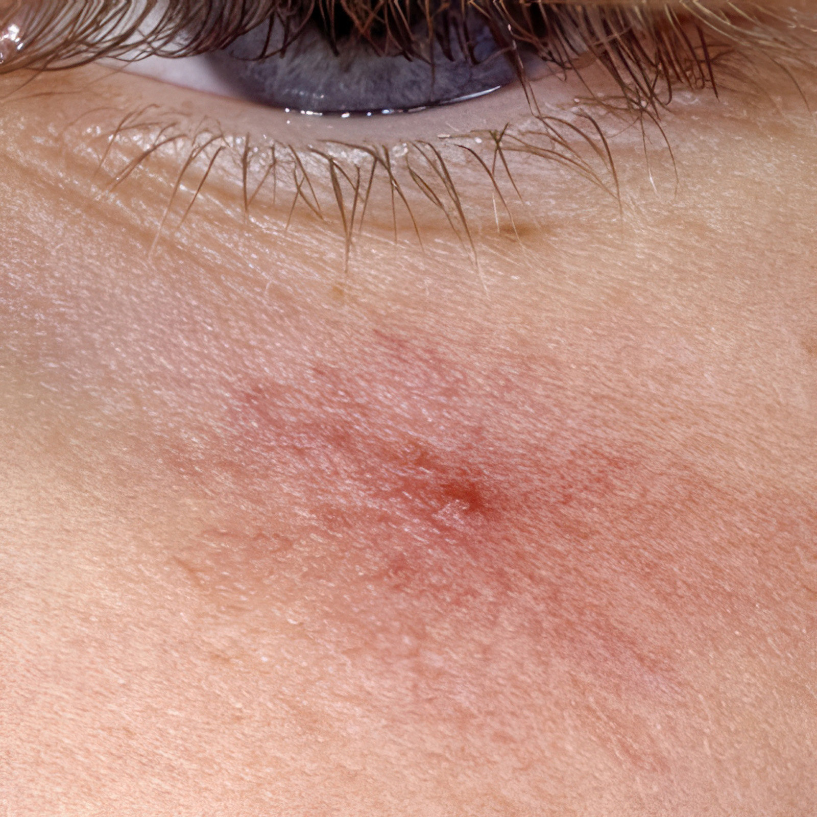 Image of a woman with a lighter skin tone who shows signs of a spider angioma | American Academy of Dermatology (AAD)
