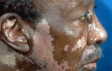 Vitiligo skin condition on a man's face