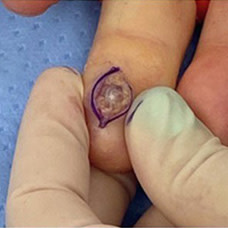 A man's finger has been surgically opened to reveal a digital papillary adenocarcinoma under the skin. 