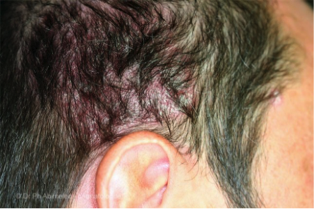 scalp psoriasis on man's head