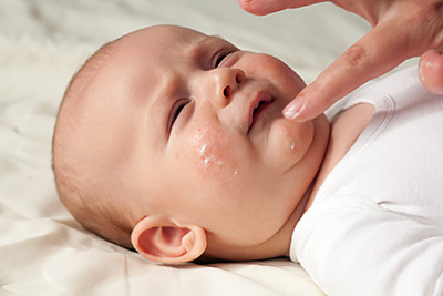 Infant treated for eczema
