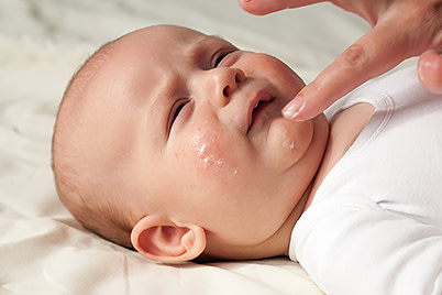 Infant treated for eczema