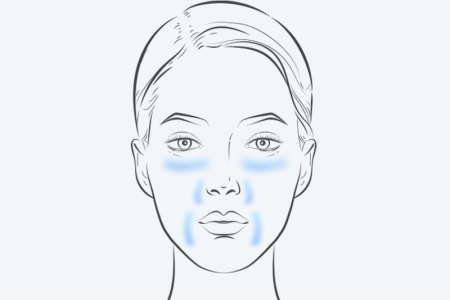 Illustration shows where to apply moisturizer to reduce skin irritation caused by a retinoid