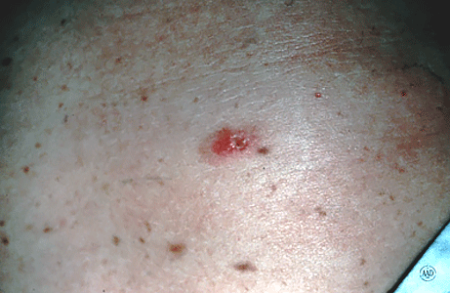 Close-up of a melanoma that looks like a sore