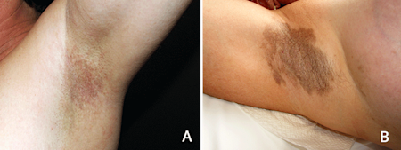 Inverse lichen planus in armpit (A), Darkened patch in armpit due to lichen planus (B)