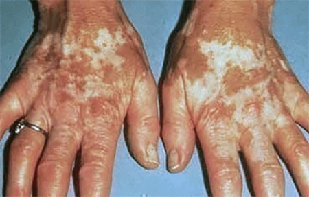 Vitiligo skin disease on a woman's hands