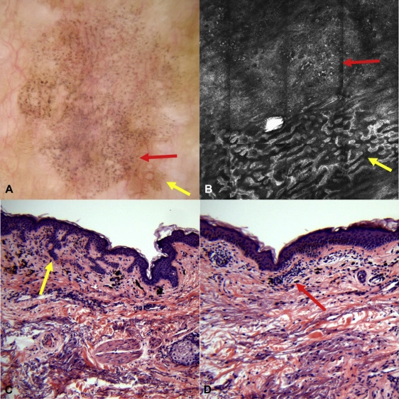 Reflections on reflectance confocal microscopy for diagnosing benign ...