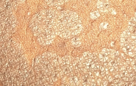 Dry and scaly spots of the skin condition tinea versicolor