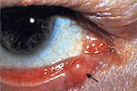 Sebaceous carcinoma is a type of skin cancer that often develops on the eyelid.