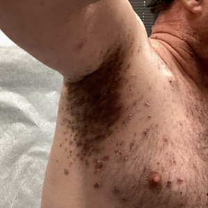 Image of PRIDE reaction to drug treatment for DWII