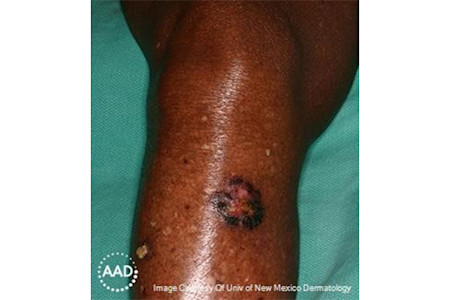 The squamous cell carcinoma on this Black patient’s leg looks like a sore ringed by black, raised skin | American Academy of Dermatology (AAD).