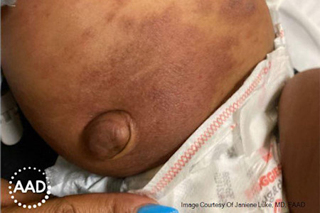 Dark brown-to-purple baby eczema rash