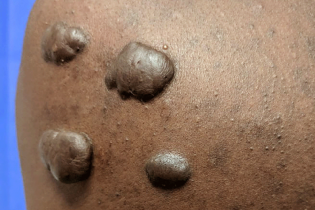 keloid scars due to acne
