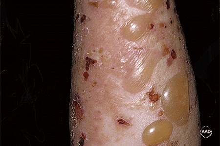 Severe bullous pemphigoid