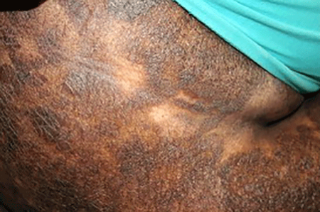 Cutaneous T-cell lymphoma can cause scaly, raised patches that are darker than your skin or light spots