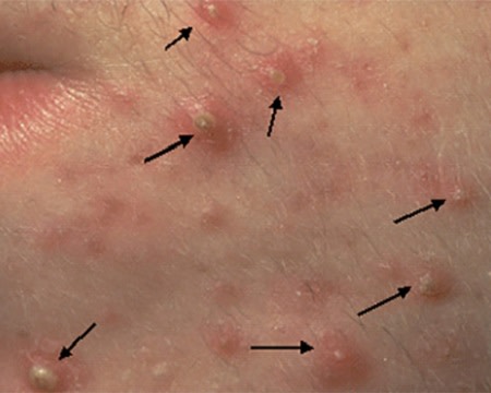 Pus-filled pimples