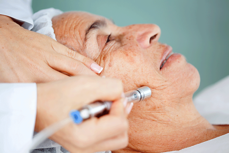 Microdermabrasion treatment on a senior woman