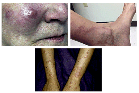 Early signs of leprosy