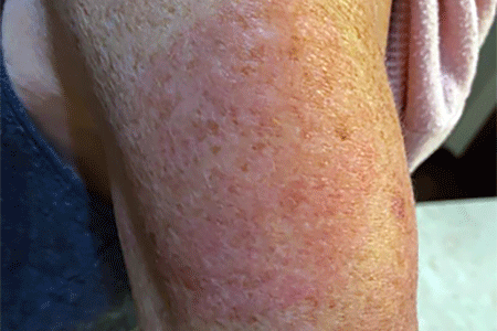 COVID arm rash