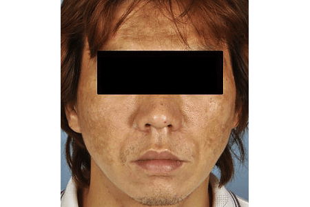 Melasma on man’s face