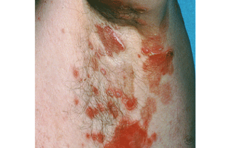 Pemphigus vulgaris blisters and sores