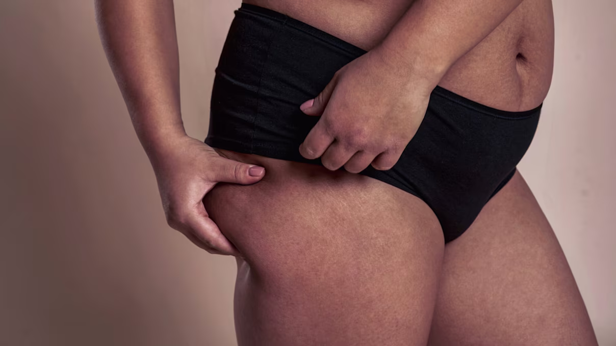 How to Get Rid of Saddlebags: Achieve Sleeker Silhouette with These Tips