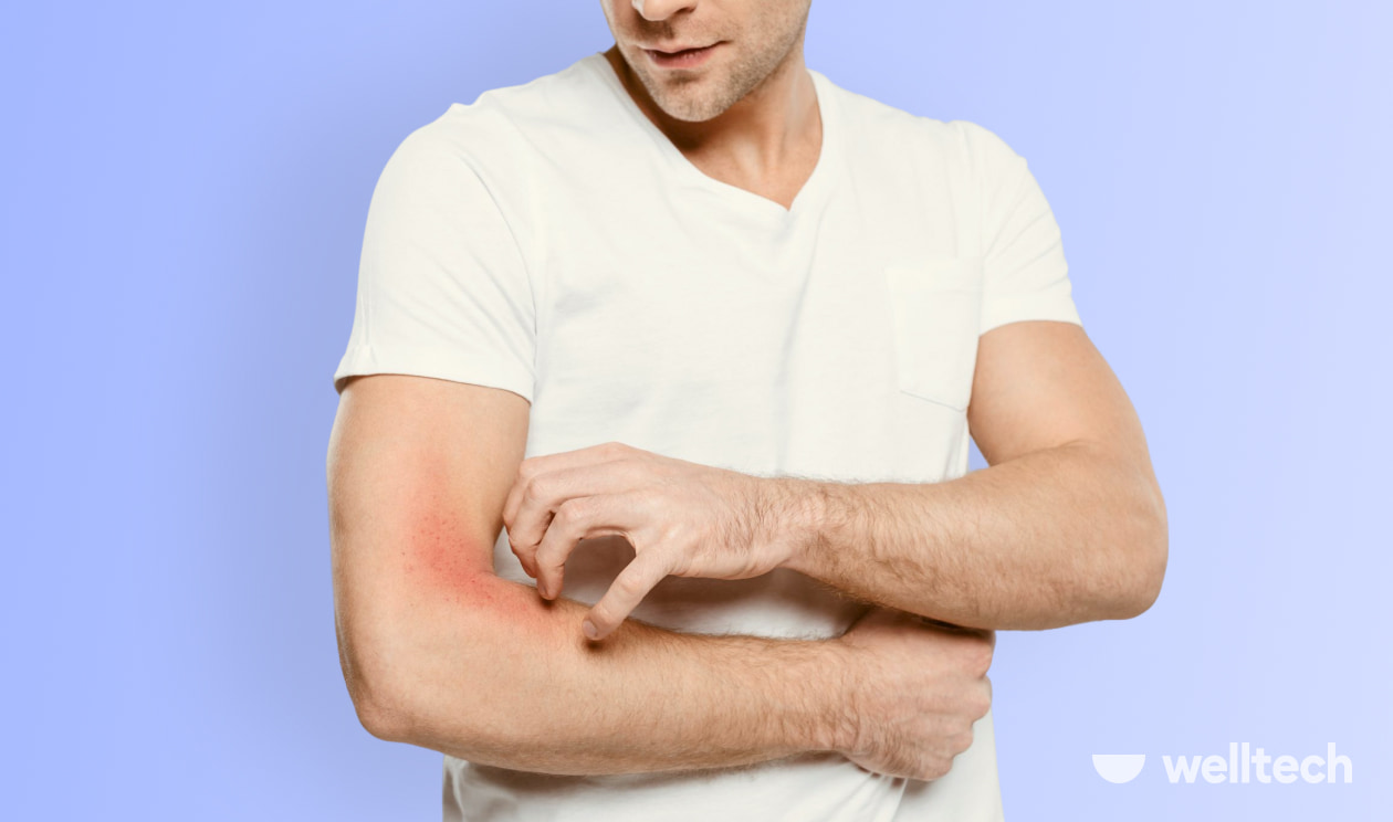 Why Does Pre-Workout Make You Itch? (& How to Stop It) 