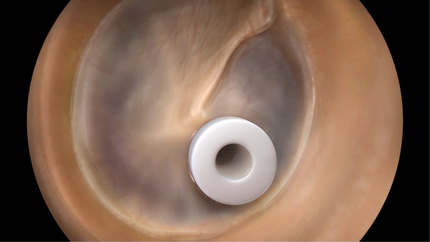 ear canal with tube